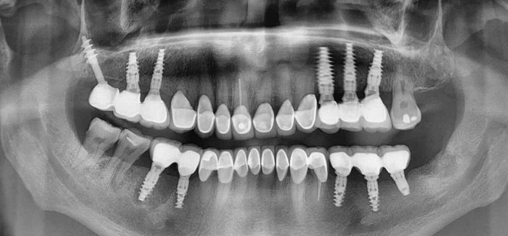 Можно ли с зубным имплантом делать мрт. Компьютерная томография челюсти снимок. Рентген зубов верхней челюсти. Рентген зубов с имплантами. Кт зубов.