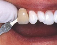 Как долго держится эффект от профессионального отбеливания зубов?