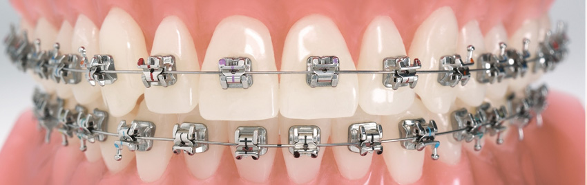 Ортодонтия: исправление прикуса, выравнивание зубов